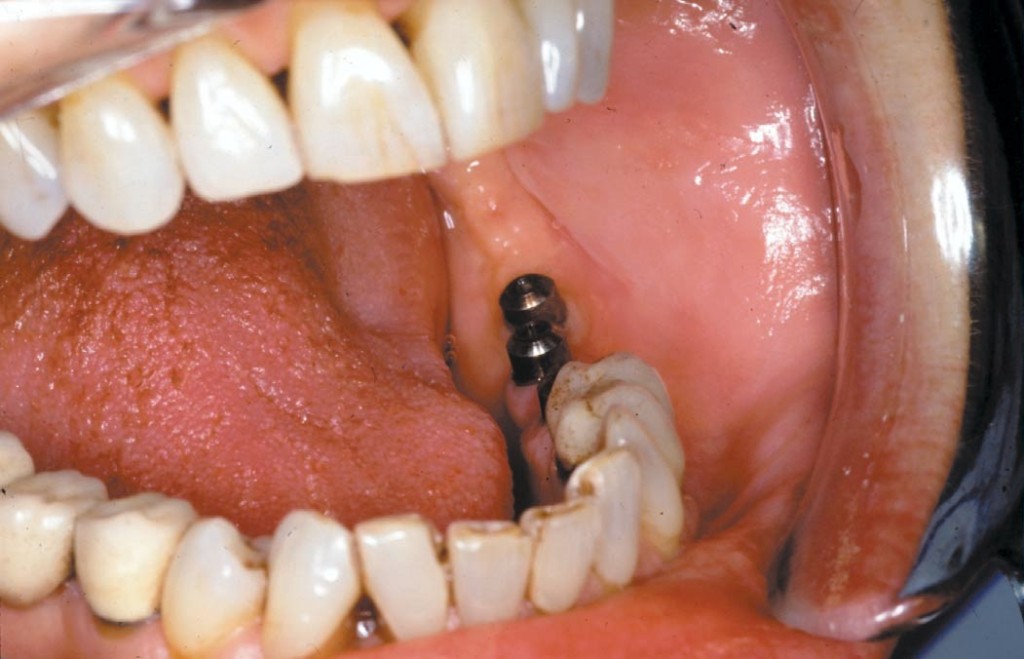 Ryc. 1. Śruby gojące (913) w miejscu 3 wszczepów O.N.B. uzupełniających braki zębów 36 i 37 (przypadek 1).