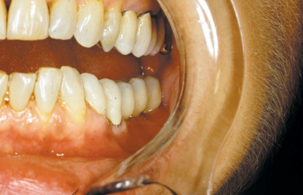 Ryc. 10. Most odbudowujący zęby 36 i 37 po zacementowaniu w ustach pacjenta (przypadek 1).