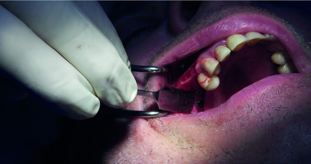 Fig.14 : Implants posés (Anthogyr Axiom Regular).