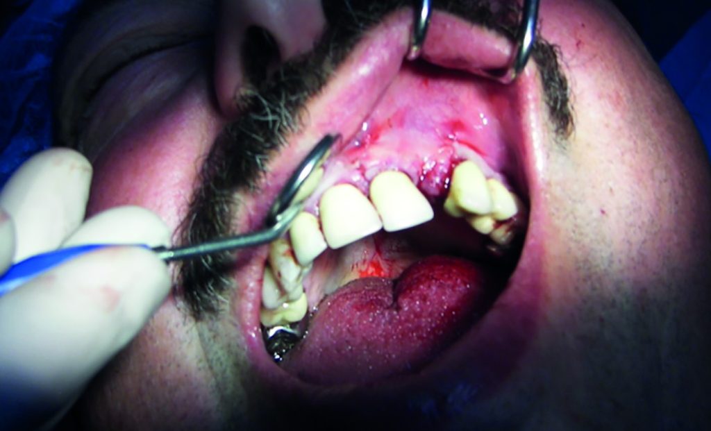 Fig.21 : Cas terminé après repositionnement du lambeau et sutures.