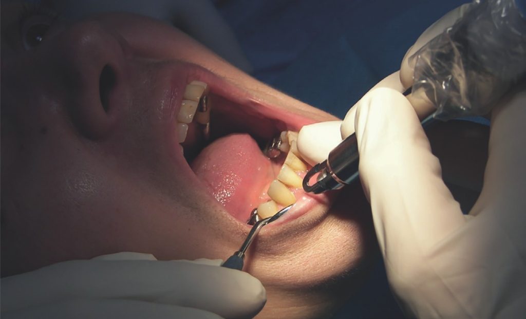 Fig.1 : Extraction et implantation d’une canine mandibulaire.