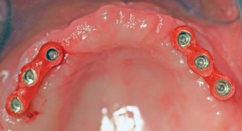 Figs. 7a & 7b_The customized abutments are mounted on the implants using a transfer key. 